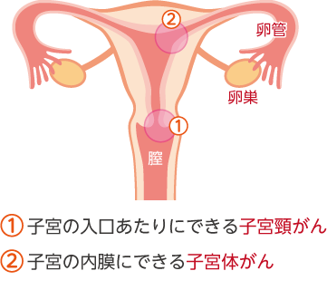 子宮がんの種類